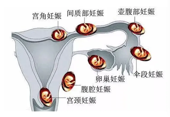 什么是异位妊娠（宫外妊娠）？