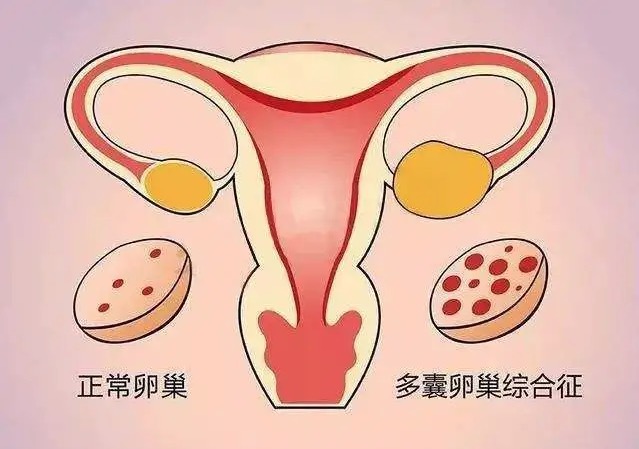 什么是PCOS？