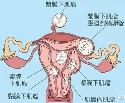 什么是子宫纤维瘤？