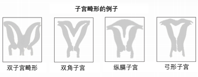 女性生殖器官畸形（苗勒氏管畸形）有哪些类型？