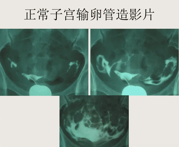 什么是子宫输卵管造影术（HSG）？