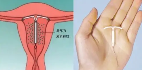 什么是宫内节育器（IUD）？