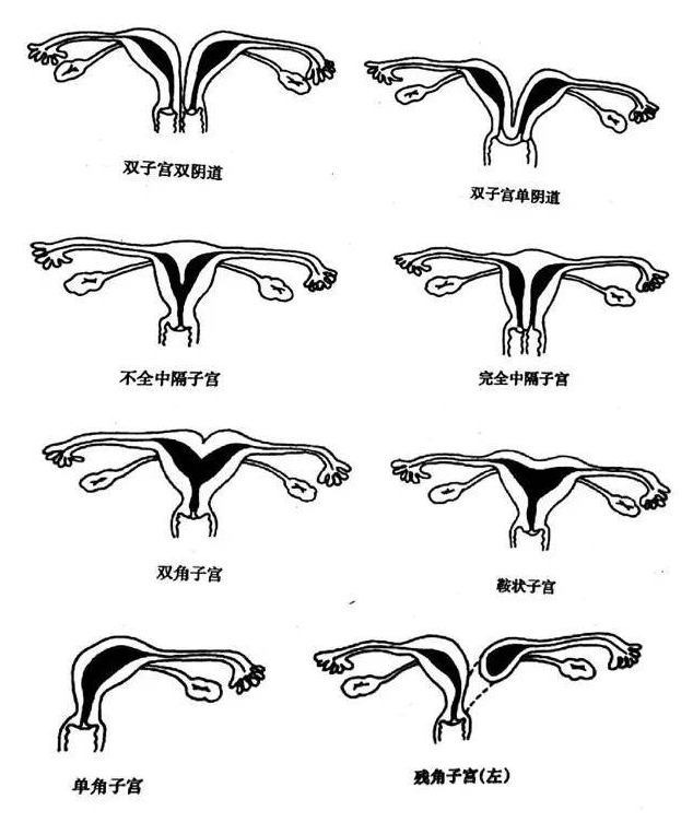 什么是子宫畸形？