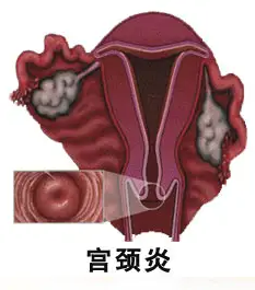 什么是宫颈炎？