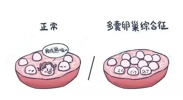 什么是多囊卵巢综合征？