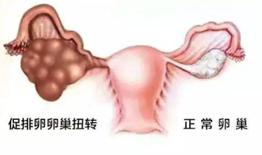 什么是卵巢扭转？