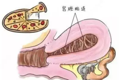 什么是子宫粘连和疤痕？