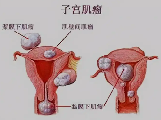 什么是子宫肌瘤？