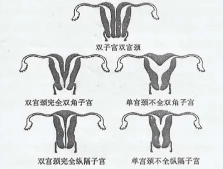 子宫畸形怎么治疗？