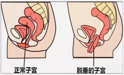 什么是子宫脱垂？