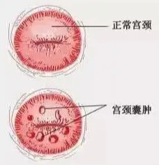 什么是阴道囊肿和病变？