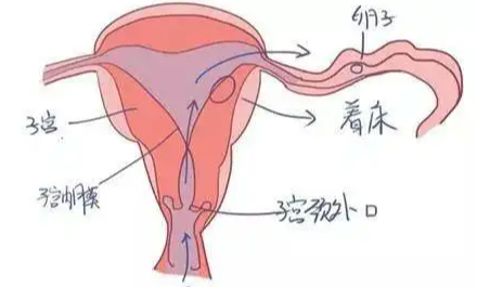 什么是先天性阴道异常？