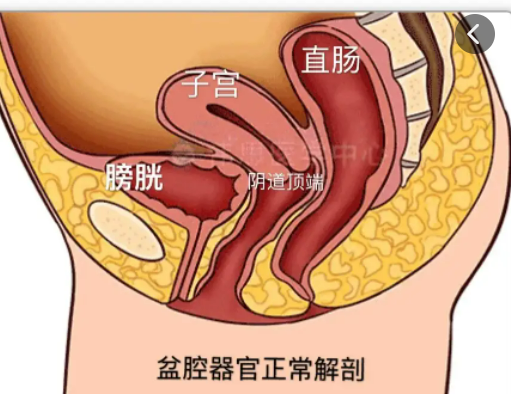 什么是膀胱膨出？