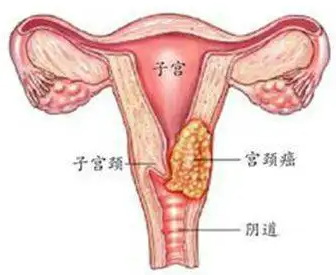 什么是阴道癌前病变？