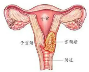 什么是阴道癌？