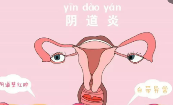 什么是阴道感染？