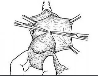 什么是前庭大腺囊肿？