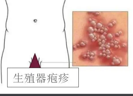 什么是生殖器疱疹？