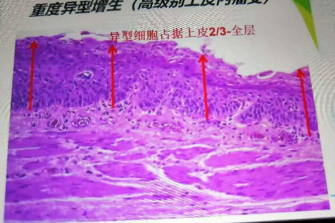 什么是外阴上皮内瘤变？