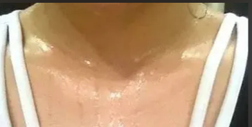 什么是更年期后盗汗和潮热？原因和治疗方案