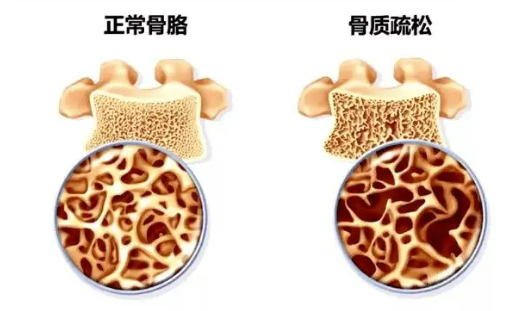 什么是绝经期间的骨质疏松症和骨质减少症？原因和治疗方案