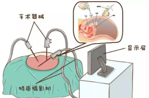 什么是诊断性腹腔镜检查？
