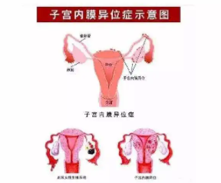 什么是子宫内膜异位症?微创腹腔镜手术