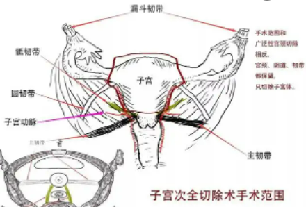 什么是子宫切除术？