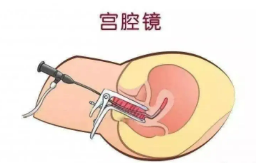 什么是宫腔镜检查？