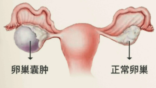 什么是腹腔镜卵巢囊肿切除术？