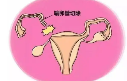 什么是输卵管切除术？