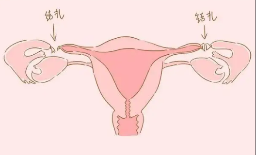 什么是输卵管结扎和输卵管结扎逆转？