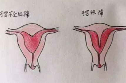 什么是阴道和子宫中隔矫正手术？