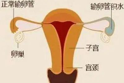 试管婴儿期间出现宫腔积液会影响成功率吗？