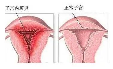 试管婴儿期间出现宫腔积液会影响成功率吗？