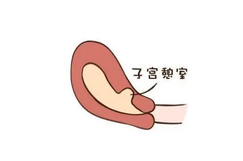 试管婴儿期间出现宫腔积液会影响成功率吗？