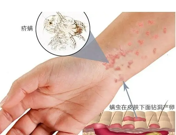 疥疮有什么症状？