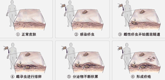怎么知道是否有疥疮？