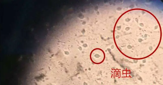 如何避免感染滴虫病？