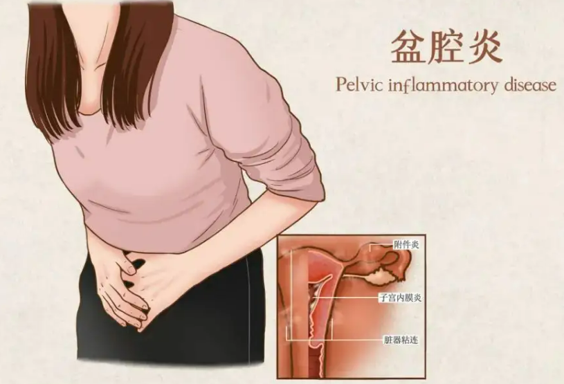 盆腔炎（PID）相关疼痛的怎么治疗？