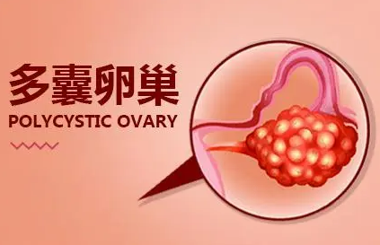 多囊卵巢综合征患者如何怀孕？