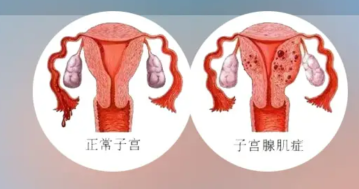 什么是子宫腺肌症和阿舍曼综合症？