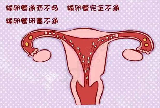 输卵管堵塞的原因以及如何诊断？