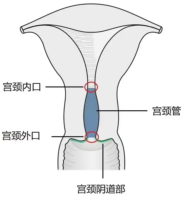 宫颈狭窄会导致不孕吗？
