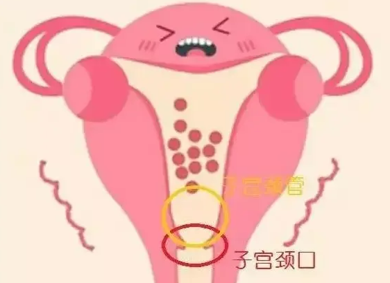 宫颈狭窄如何治疗？
