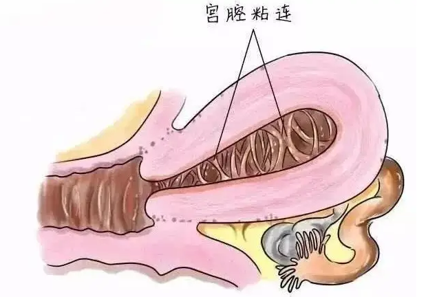 什么是粘连症状？