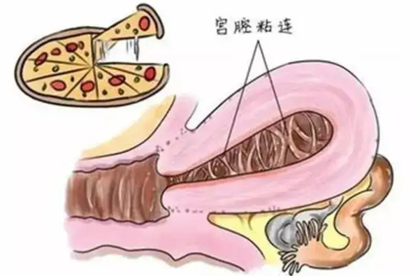 诊断粘连的主要方法有哪些？