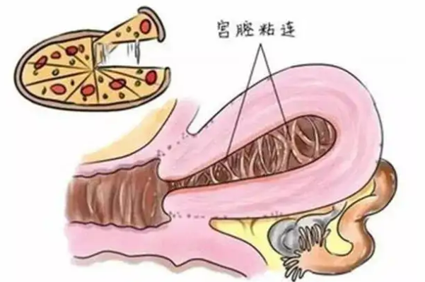 为什么粘连症状会导致不孕？