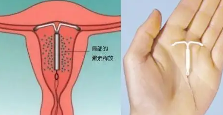 停止节育后，哪些生殖问题阻止怀孕？