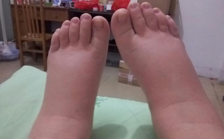 怀孕时水肿了怎么办？